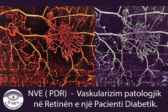 nve prd, Vaskularizim patologjik ne Retinen e nje Pacienti Diabetik, ne Qendra Shqiptare E Syve, me mjek Prof Asc Ali Tonuzi